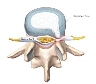 Pandemic Rehabilitation of Spine Surgery – American Industrial Magazine